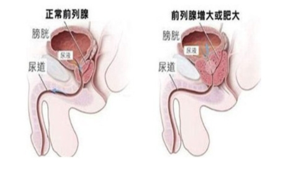 前列腺肥大的原因有什么