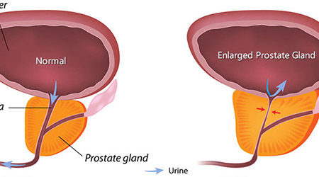 前列腺肥大