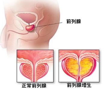 前列腺肥大