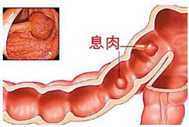 肠息肉