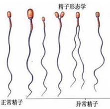 导致男性精子畸形的原因