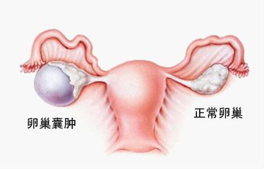 卵巢囊肿发病时的常见症状