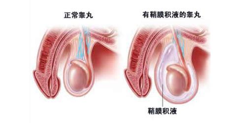 鞘膜积液发病时的症状