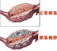 卵巢囊肿治疗前需要检查的项目